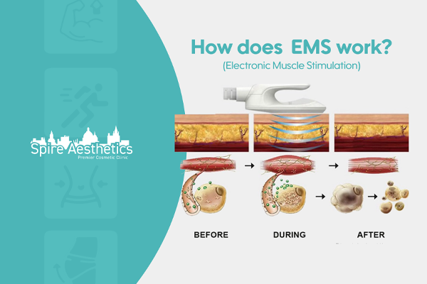 EMS treatment for post pregnancy weight loss treatment Warminster
