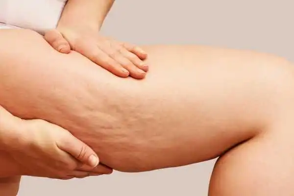 Image of woman showing leg with cellulite Warminster
