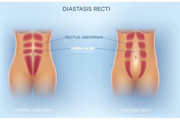 What Non-Surgical Options Are Available for Diastasis Recti Warminster?