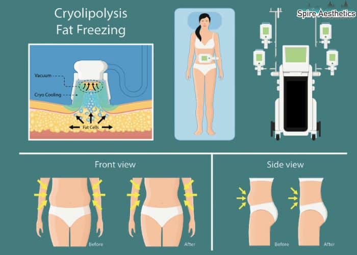 Image of diet and fat freezing combined for best results for Spire Aesthetics Warminster