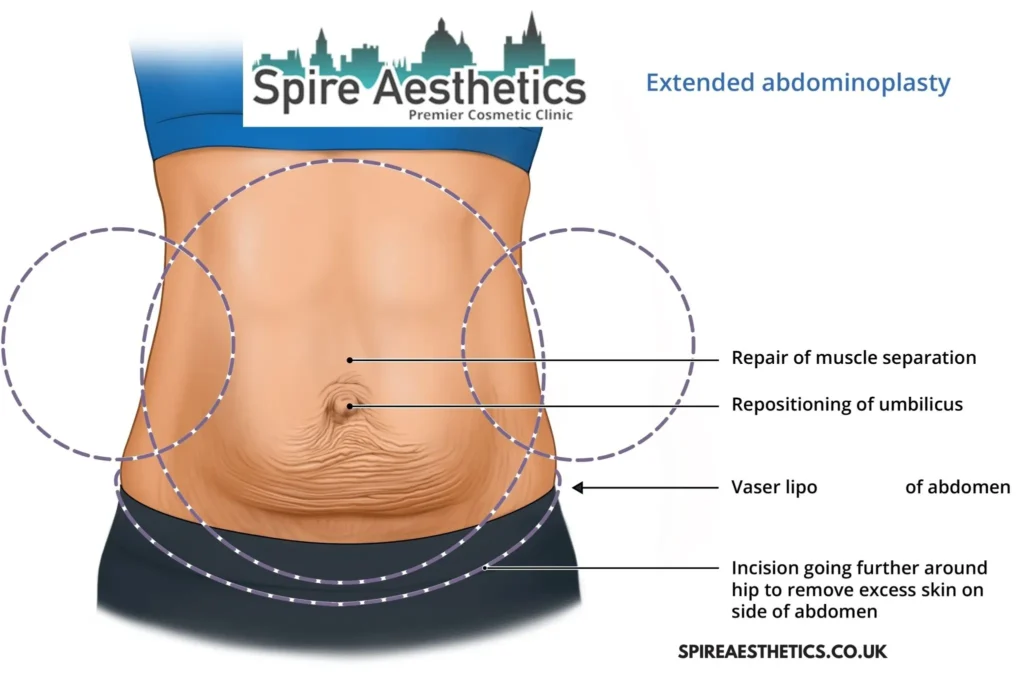 Understanding Loose Skin After Gastric Band Warminster Surgery and HIFU Treatment
