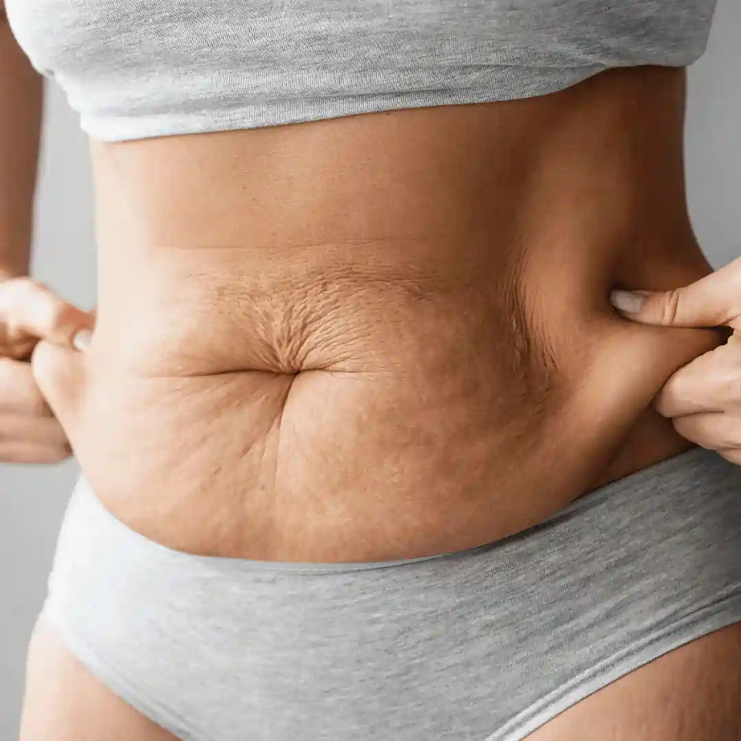 Is It Normal to Have Loose Skin After Pregnancy Warminster?