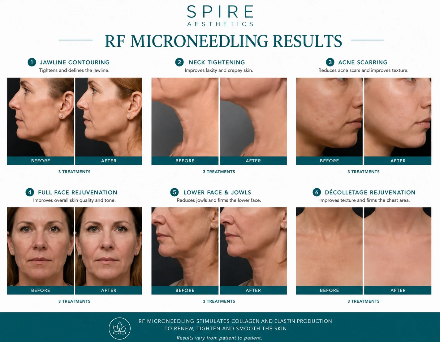 RF Microneedling Skin tightening Warminster results