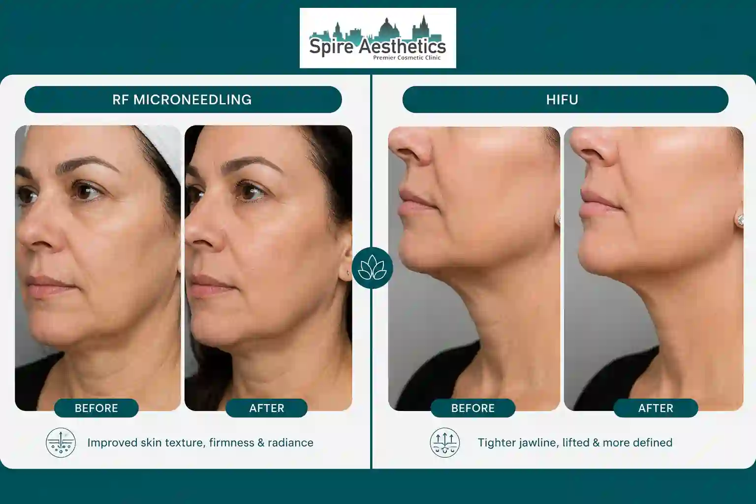 Can RF Microneedling and HIFU Be Combined Warminster?