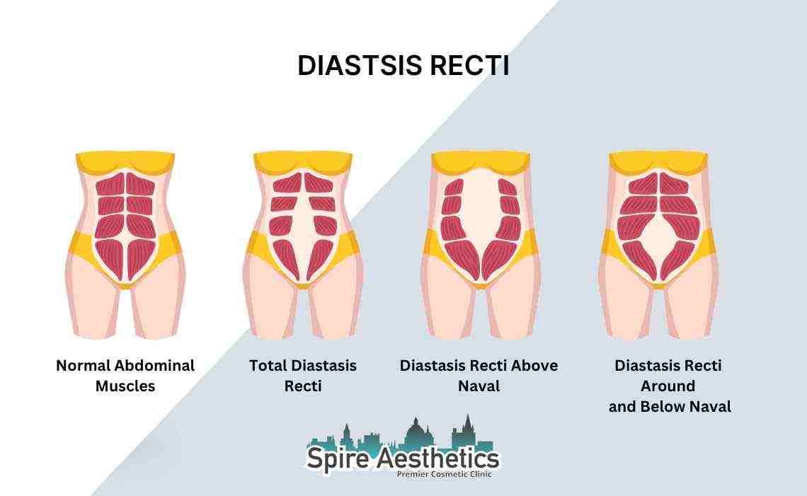 Is Non-Surgical Diastasis Recti Treatment Right for You? Common Concerns Answered Warminster